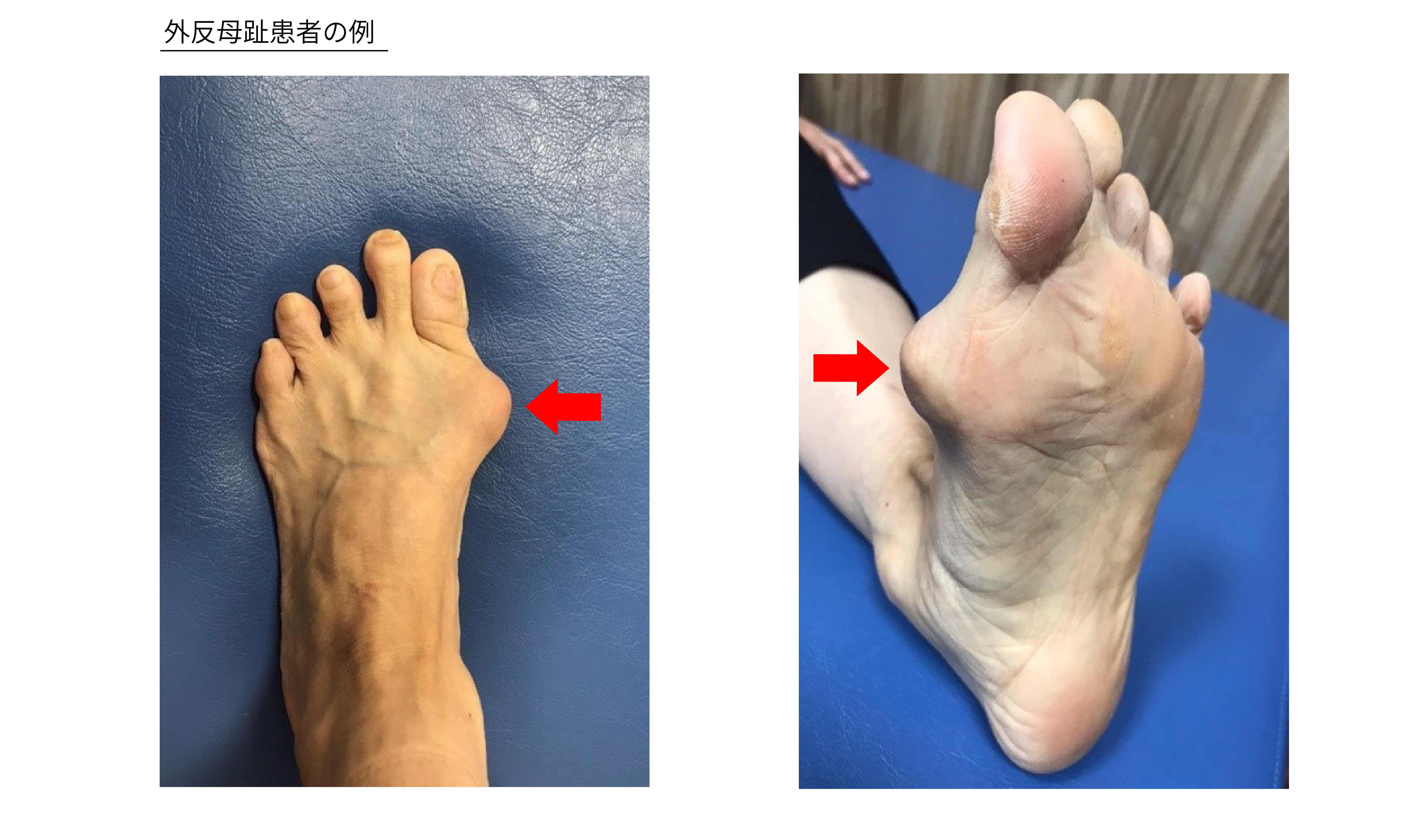 疾患修飾性抗リウマチ薬 (DMARD) について理解する